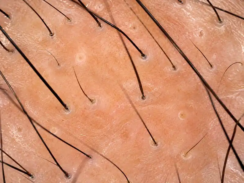 Miniaturização folicular identificado pelo exame capilar